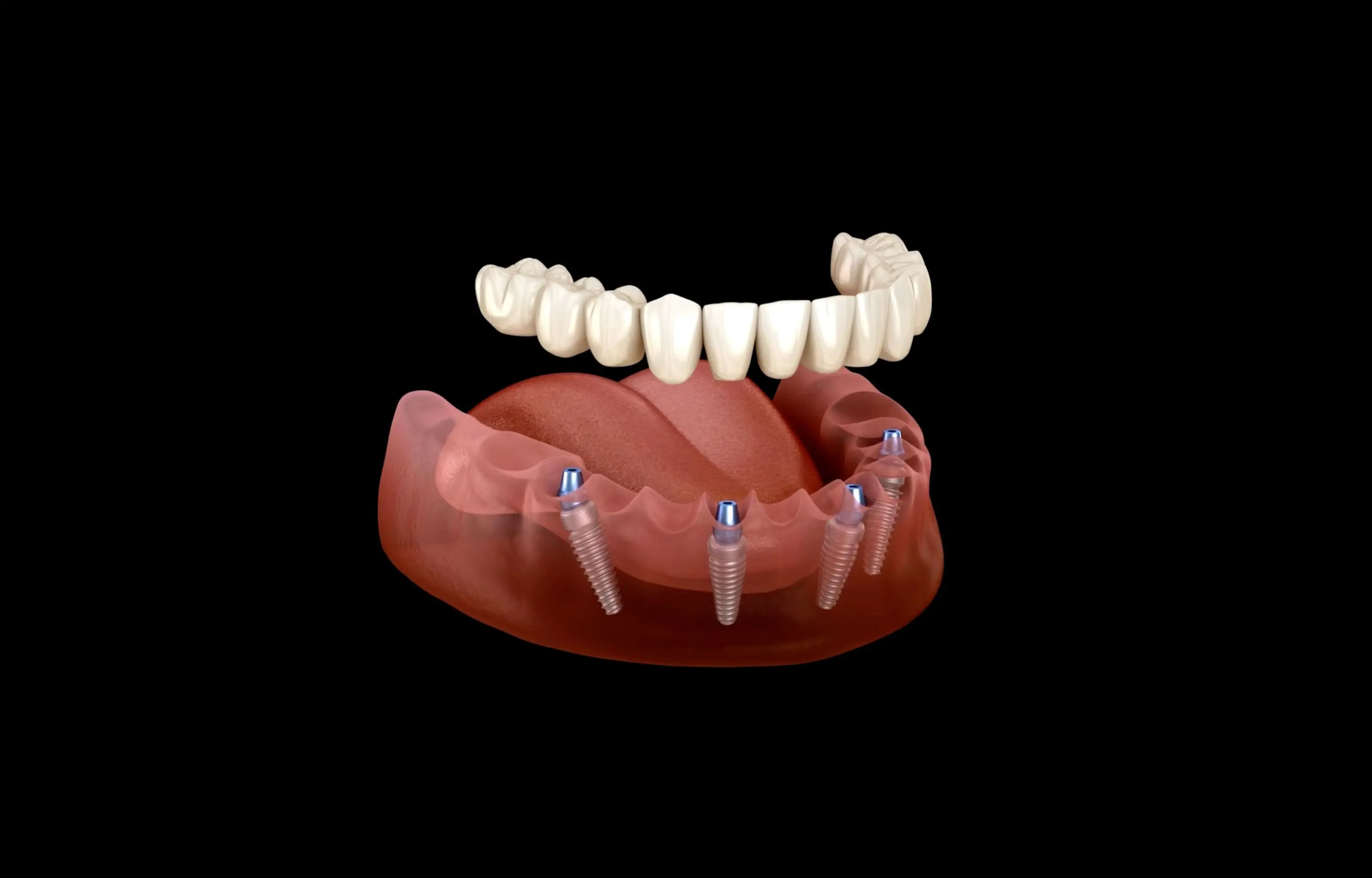 All-On-4 Dental Implants in Naples, FL